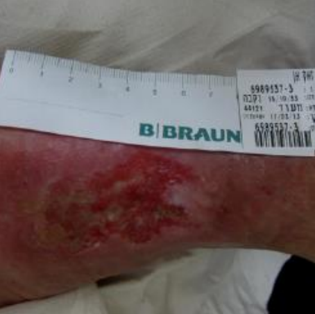 Wound care progress photo