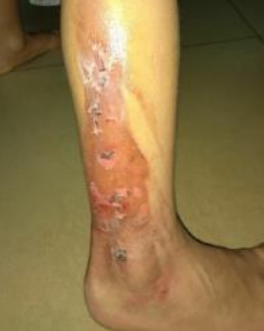 Wound care progress photo