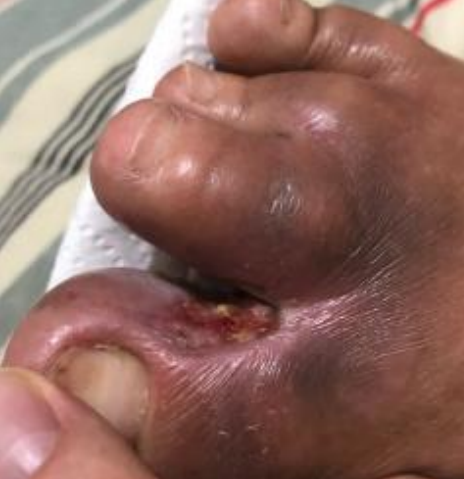 Wound care progress photo