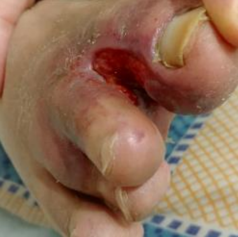 Wound care progress photo