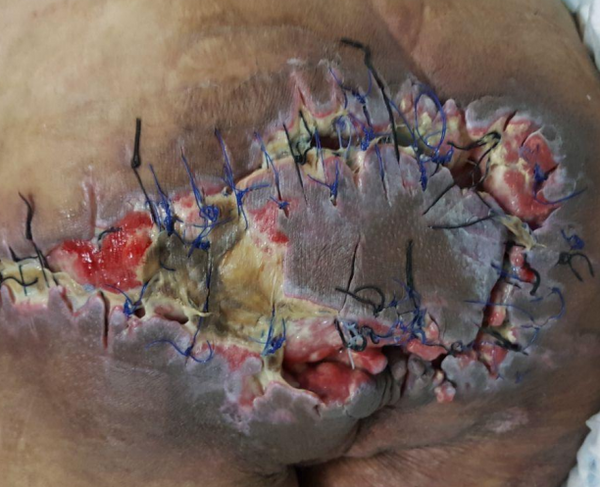 Wound care progress photo