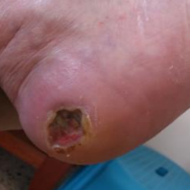 Wound care progress photo