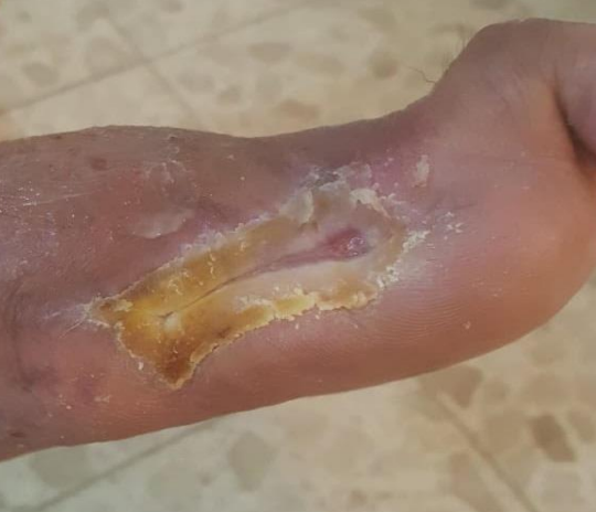 Wound care progress photo