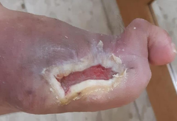 Wound care progress photo