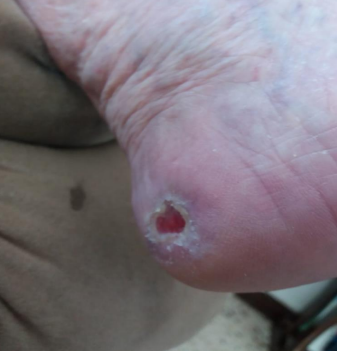 Wound care progress photo