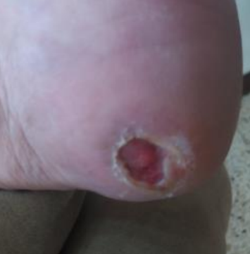 Wound care progress photo