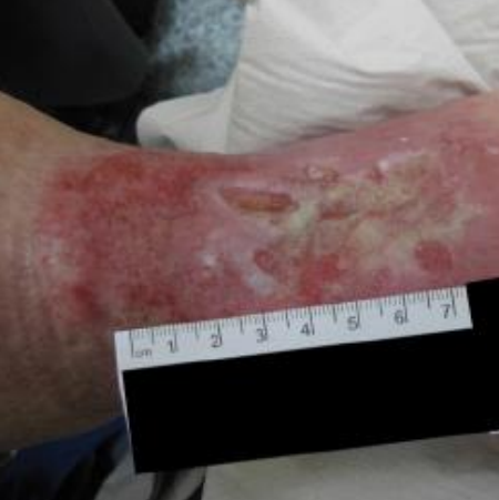 Wound care progress photo
