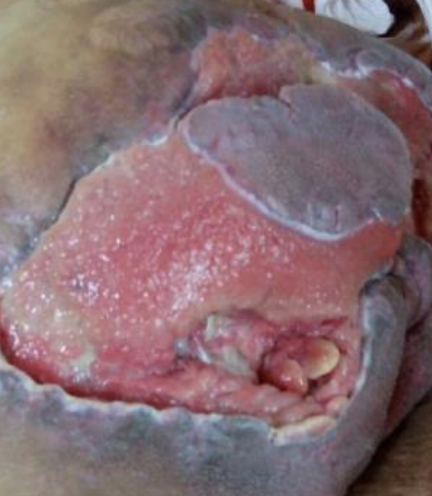 Wound care progress photo