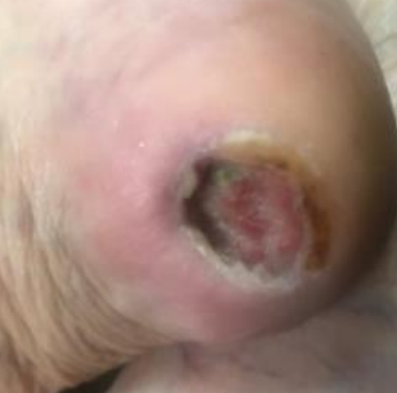 Wound care progress photo