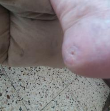 Wound care progress photo