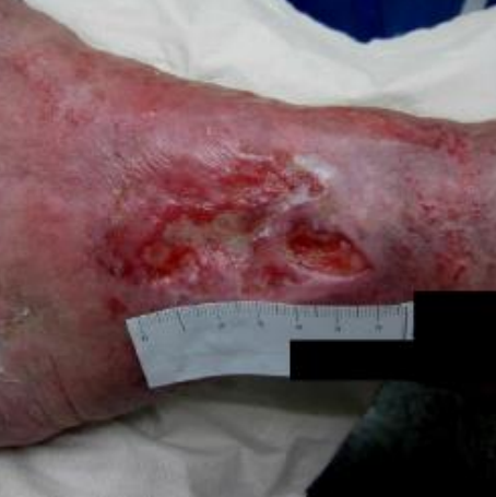 Wound care progress photo