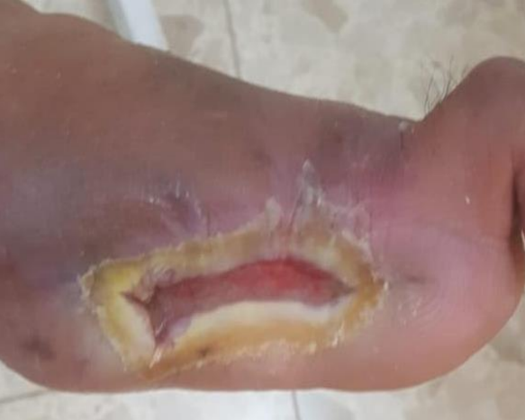 Wound care progress photo
