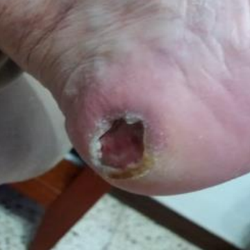 Wound care progress photo