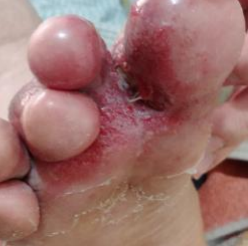 Wound care progress photo