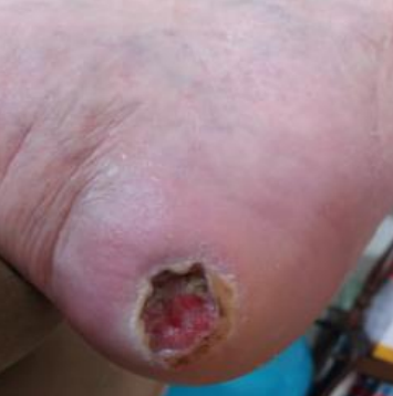 Wound care progress photo