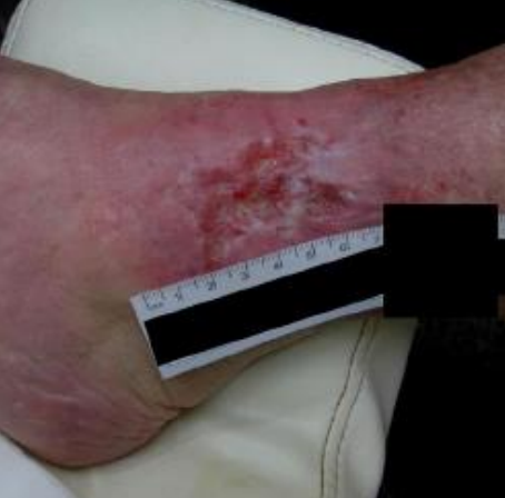 Wound care progress photo