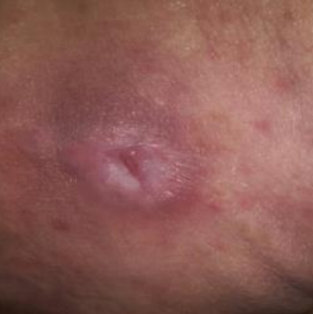Wound care progress photo