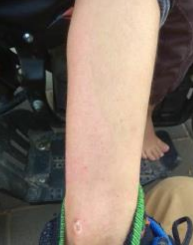Wound care progress photo