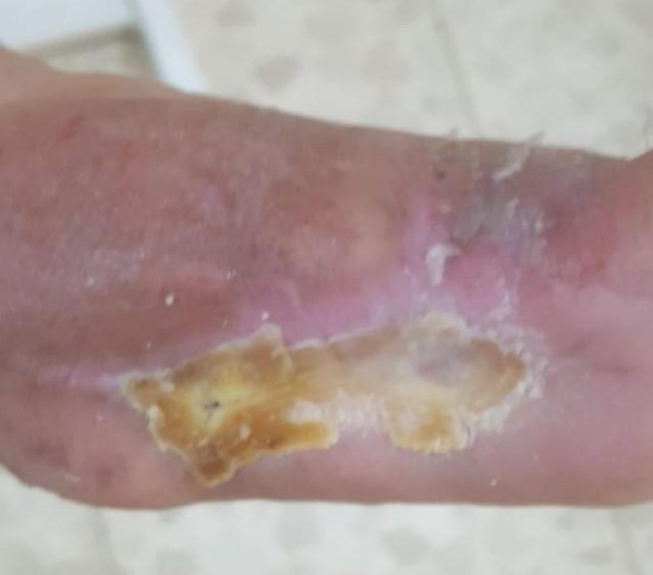 Wound care progress photo