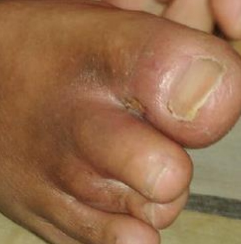 Wound care progress photo