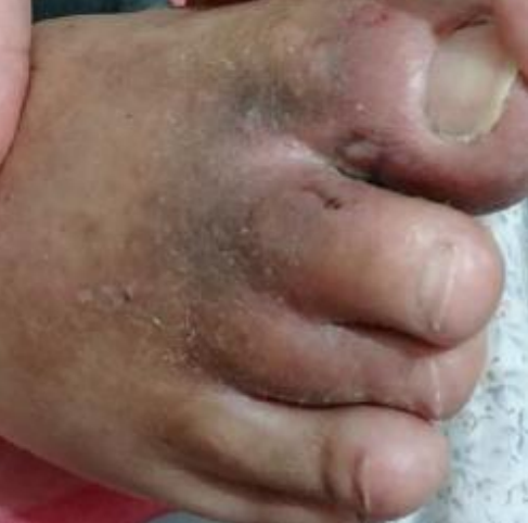 Wound care progress photo