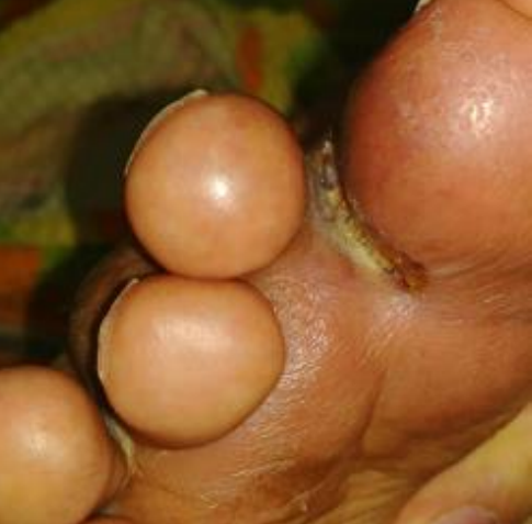 Wound care progress photo