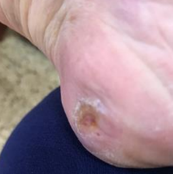 Wound care progress photo