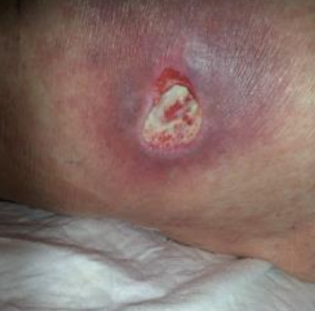 Wound care progress photo