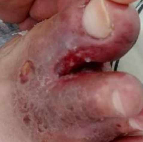 Wound care progress photo