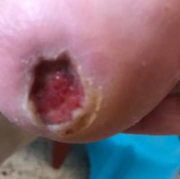 Wound care progress photo