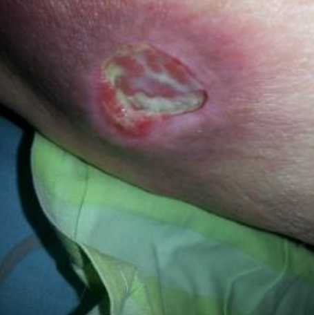 Wound care progress photo