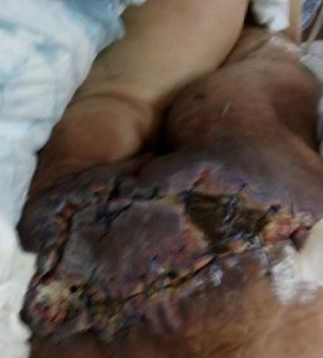 Wound care progress photo