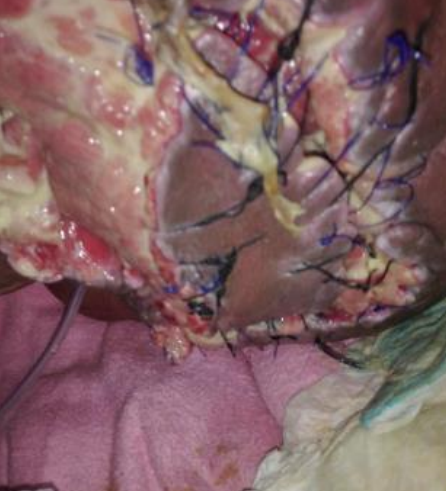Wound care progress photo