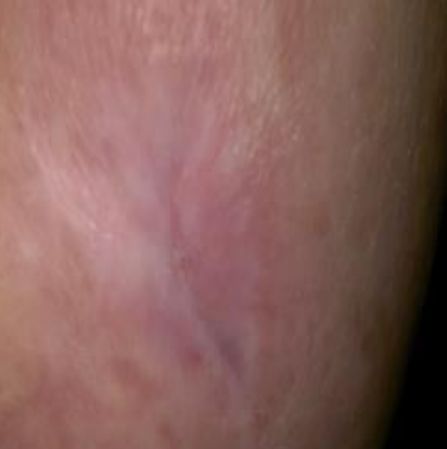 Wound care progress photo