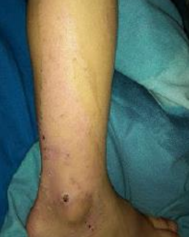 Wound care progress photo