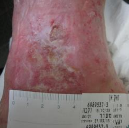 Wound care progress photo