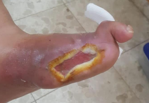 Wound care progress photo