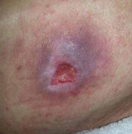 Wound care progress photo