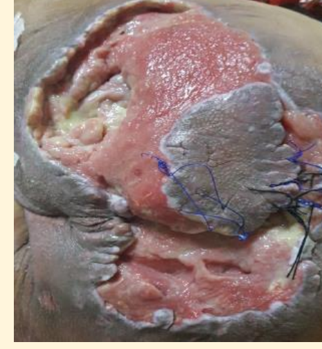 Wound care progress photo