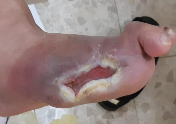 Wound care progress photo