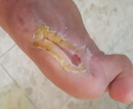 Wound care progress photo