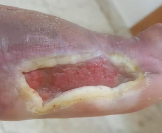Wound care progress photo