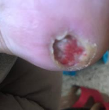 Wound care progress photo