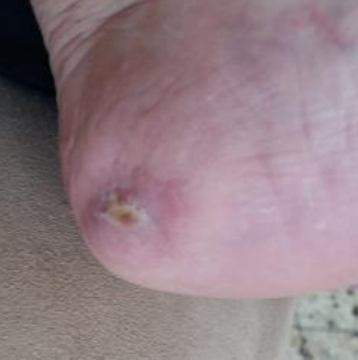 Wound care progress photo