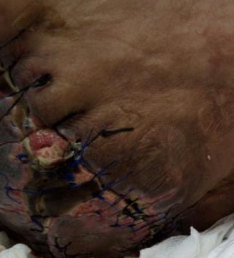 Wound care progress photo