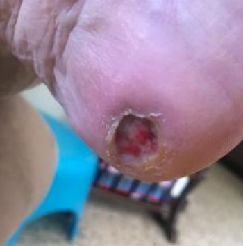 Wound care progress photo