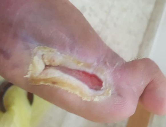 Wound care progress photo
